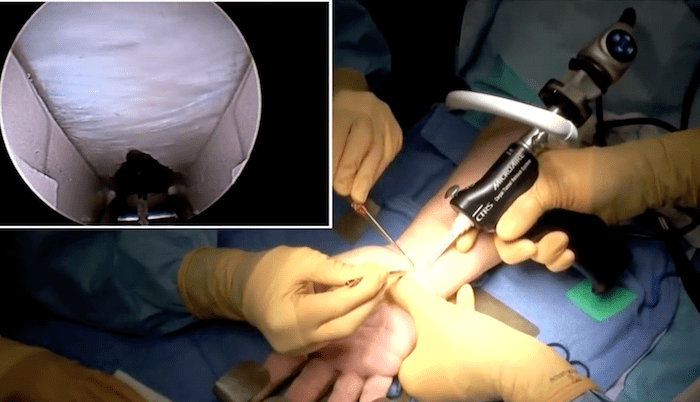 Chirurgie du canal carpien par voie endoscopique